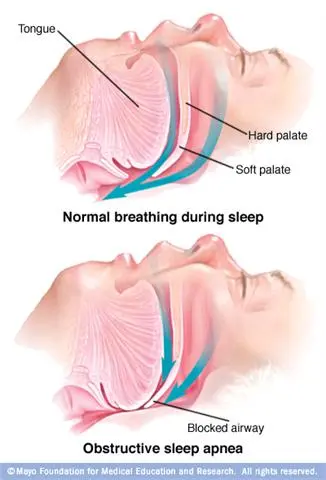 Sleep apnea treatment diagram
