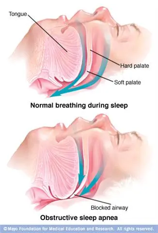 What Is Obstructive Sleep Apnea?: Central Avenue Dental