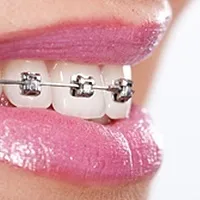 a smiling close up of a woman with braces