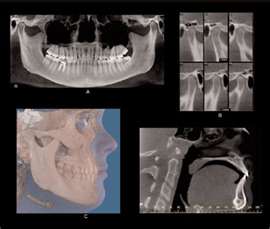 TMJ Treatment diagram