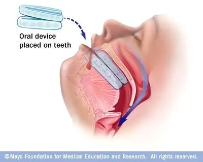 a diagram of how the treatment helps you breathe