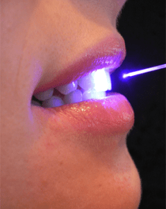 laser